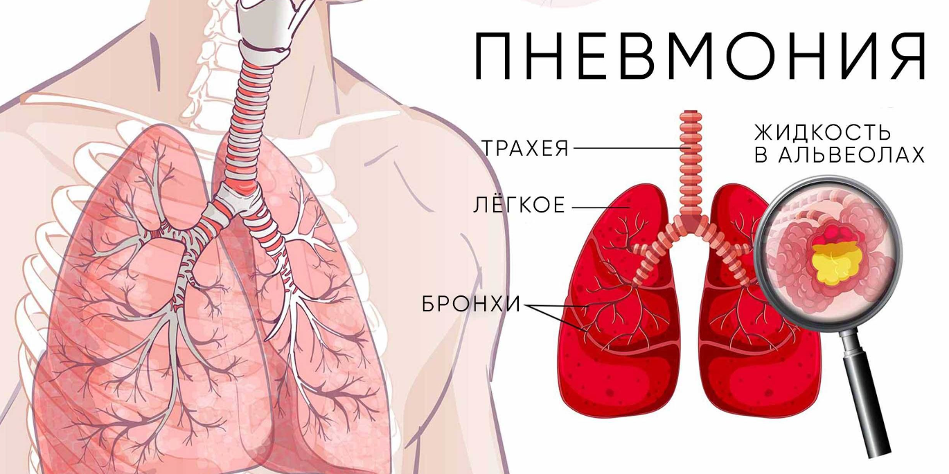 Профилактика пневмонии